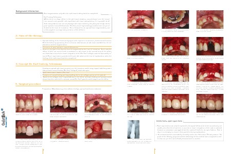 Geistlich - Indication sheets E3 - Extraction Sockets