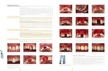 Geistlich - Indication sheets