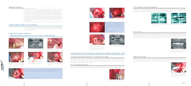 S3 - Sinus floor augmentation