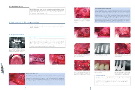 Geistlich - Indication sheets S2 - Sinus floor augmentation