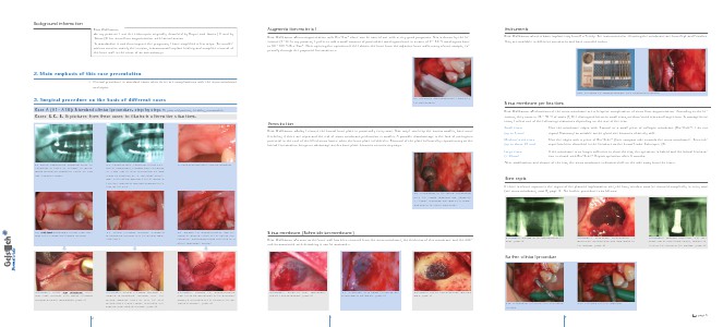 S1 -Sinus Floor Augmentation