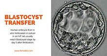 Blastocyst Transfer