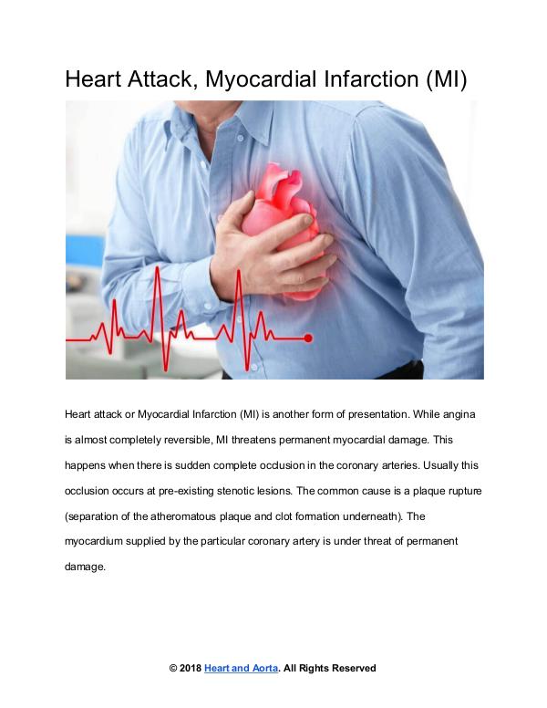 Heart and Aorta Heart Attack or Myocardial Infarction (MI)