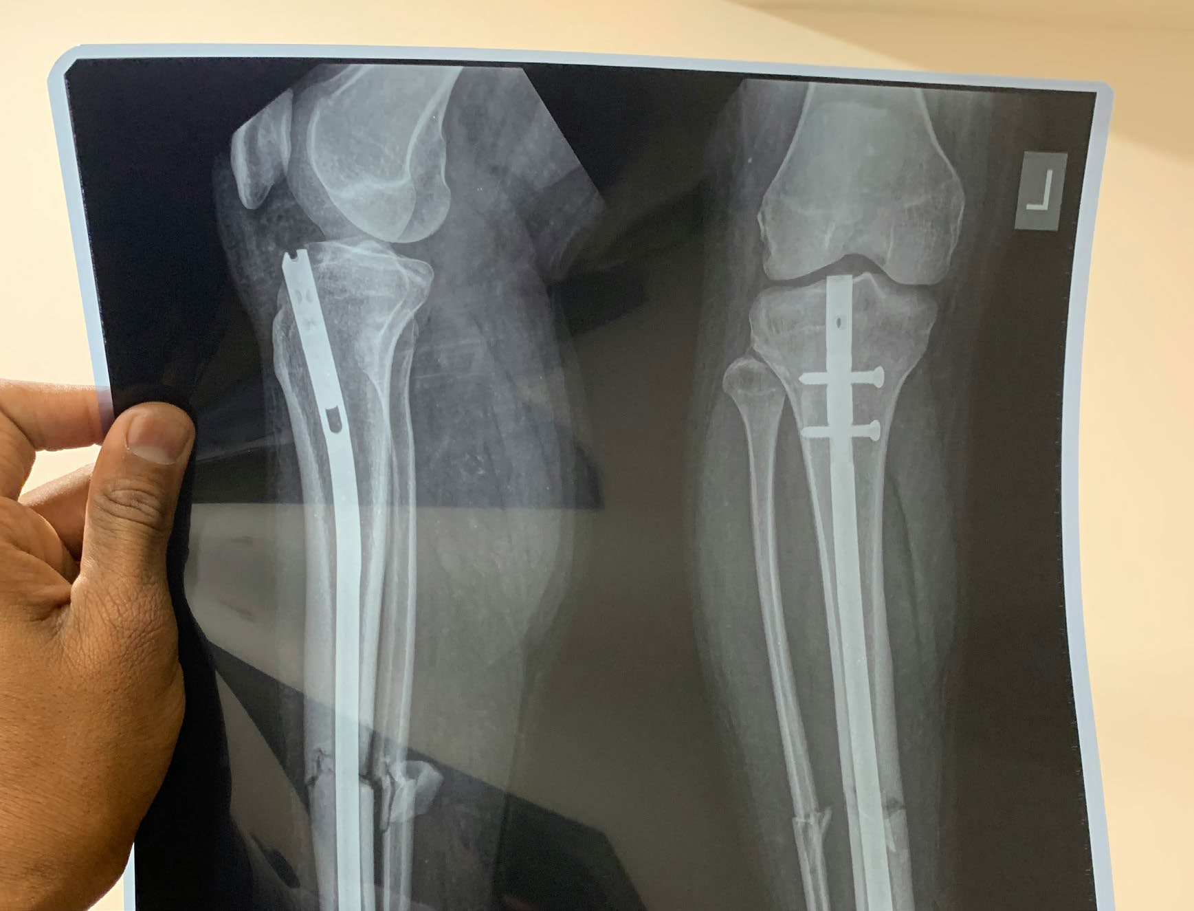 An X-ray of a leg showing surgical pins and a rod used to repair a break