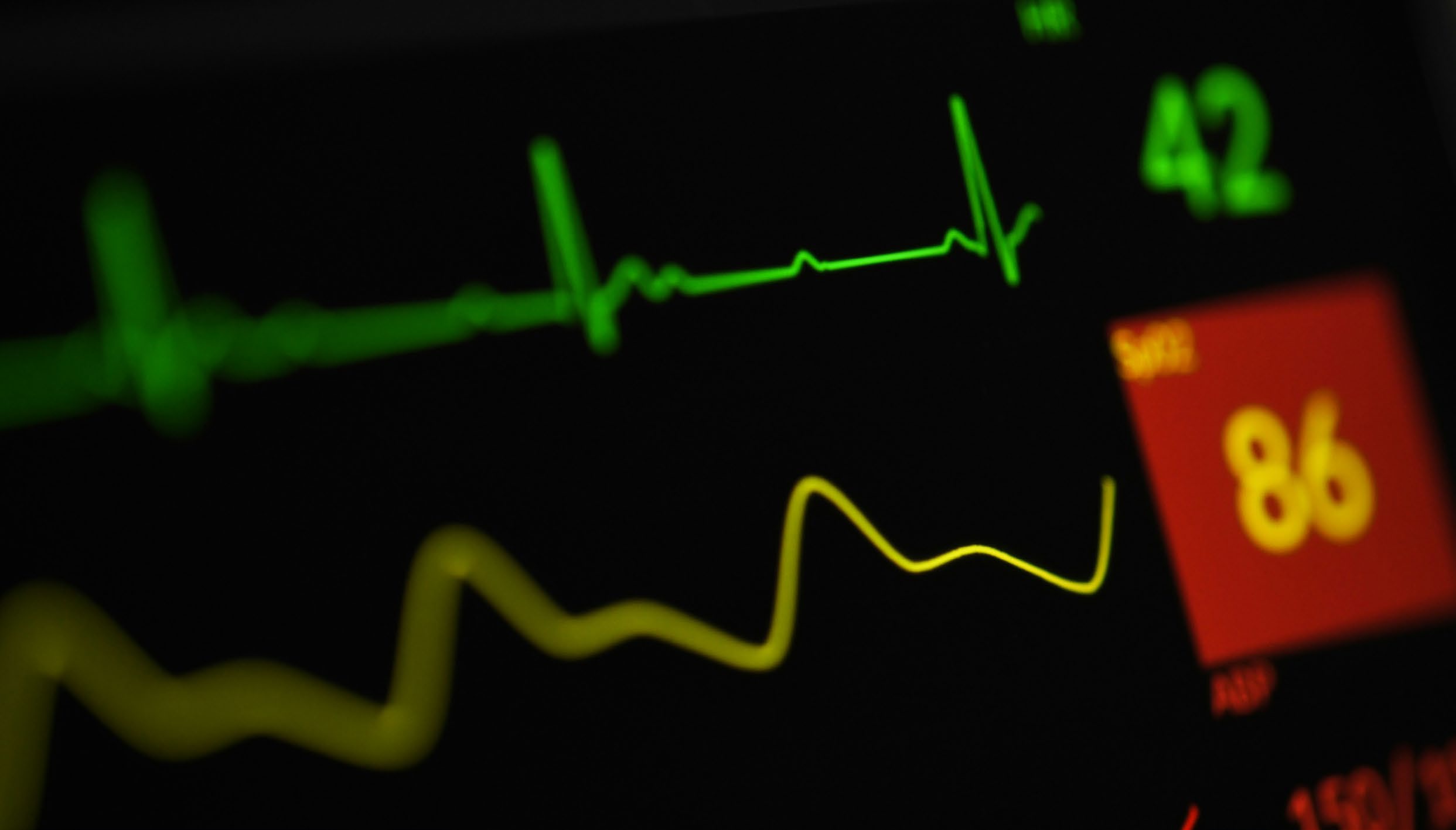 A medical monitor displaying an ECG waveform