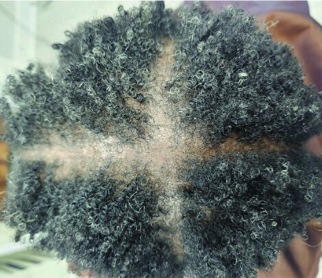 Diffuse crown thinning on tightly coiled textured hair, showing reduced density at the crown
