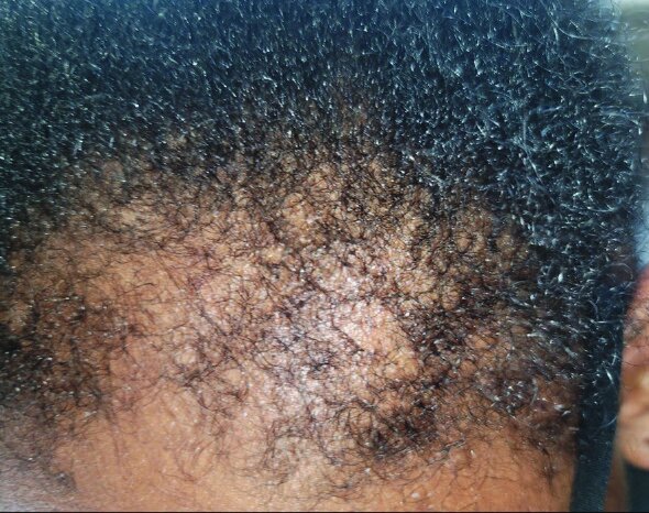 Close-up of the scalp showing sparse follicle density and miniaturized hairs