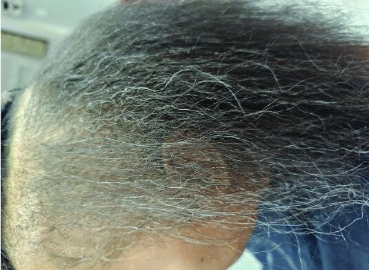Frontal hairline showing new fine regrowth and short vellus hairs